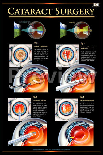 Cataract Surgery Poster