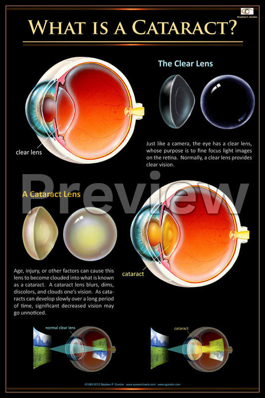 Cataract Overview Poster