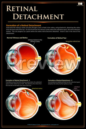 Retinal Detachment Poster